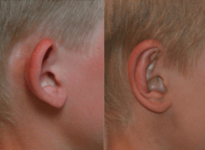 Före och efter bilder av öronplastik