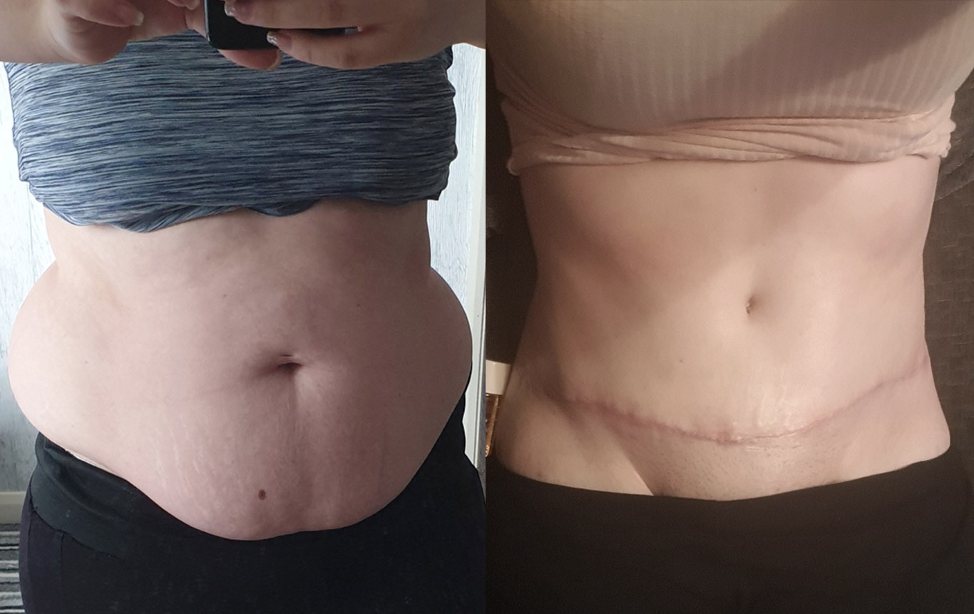 mageplastikk før og etter bilder 2