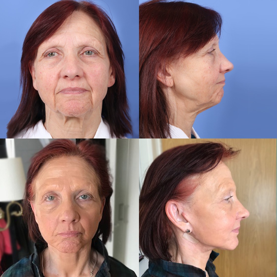 Zdjęcia przed i po lifting twarzy - Nordesthetics Clinic
