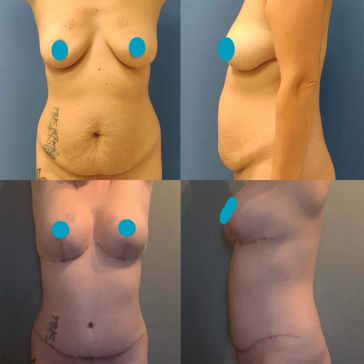 Nordesthetics clinic - The timeline for tummy tuck recovery varies