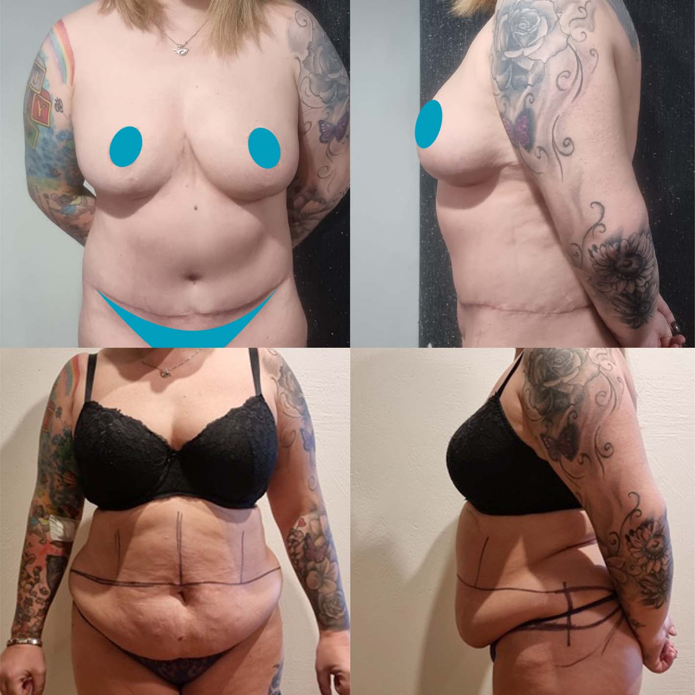 Tummy tuck before & after photos - Nordesthetics Clinic