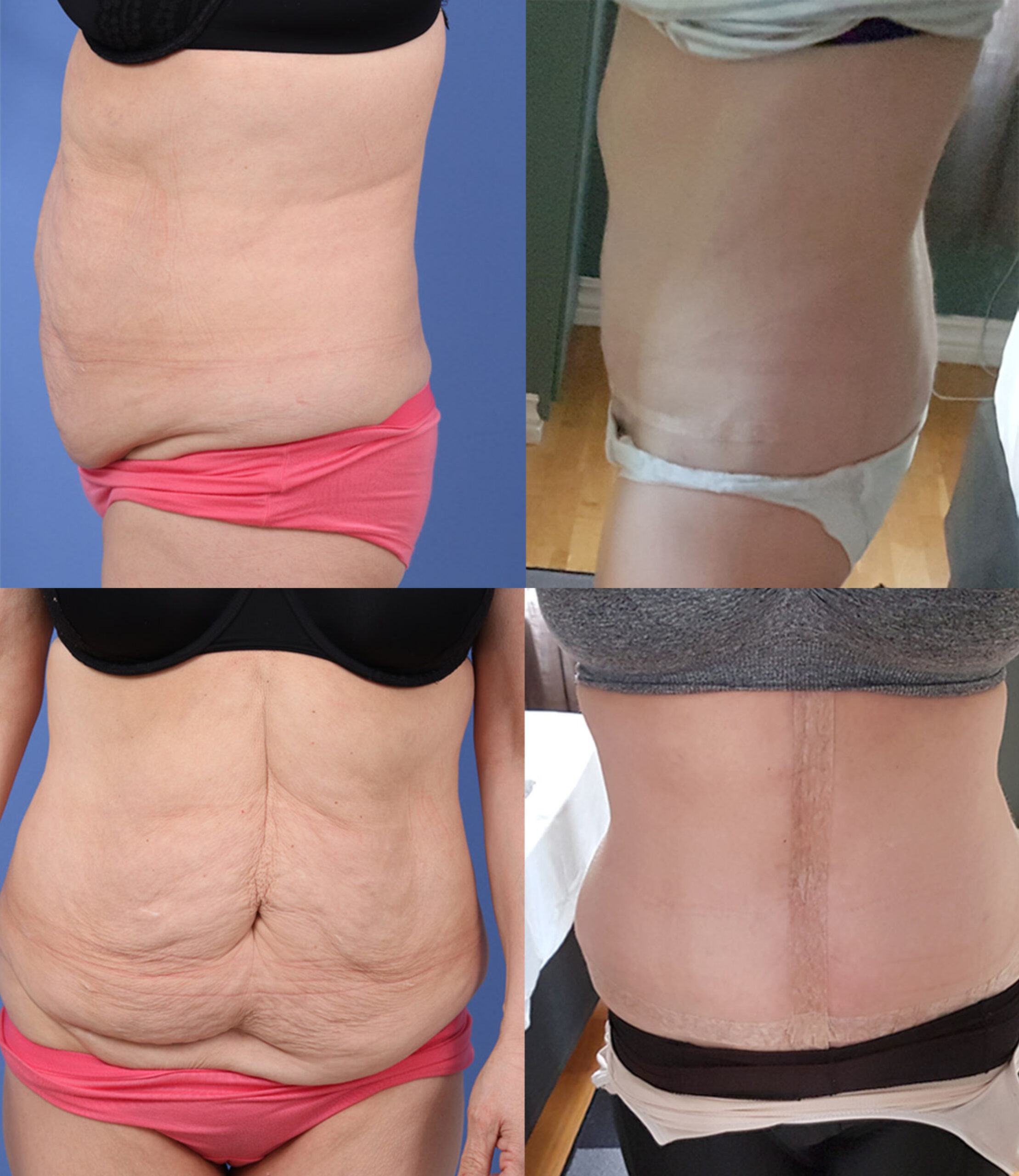Nordesthetics clinic - The timeline for tummy tuck recovery varies