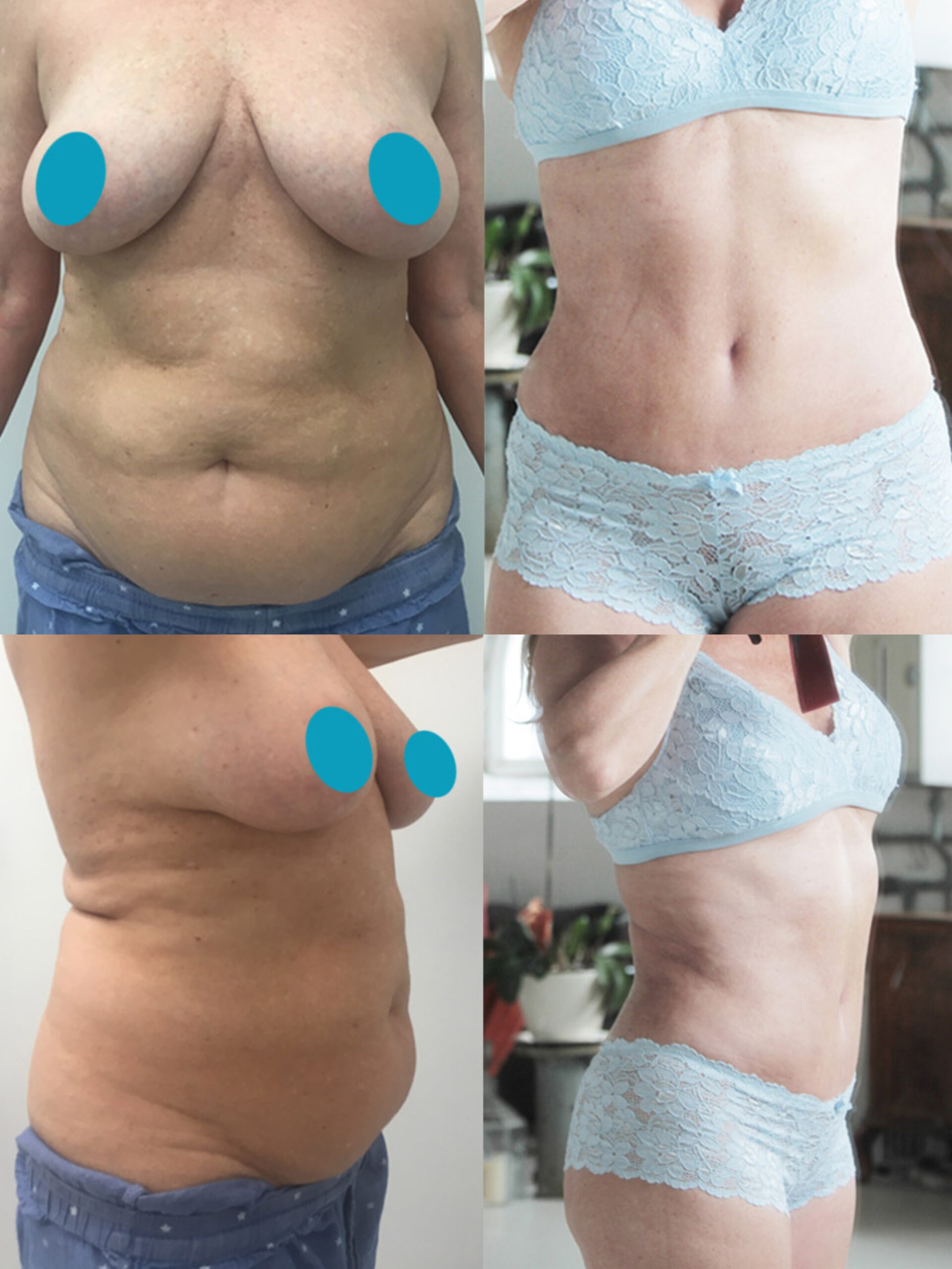 Patient 1482 Tummy Tuck, Breast Reduction, Mommy Makeover Before