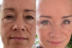 Facelift + Brow lift + Upper and lower eyelid lift