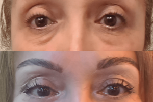 Lower eyelid surgery