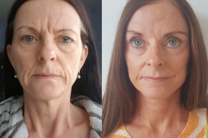 Facelift + Browlift + Upper and lower eyelid surgery