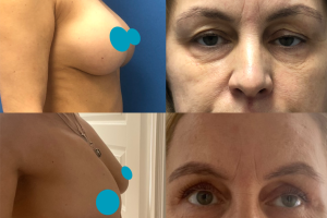 Lower eyelid surgery + Breast implant removal