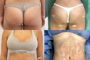 360 circumferential liposuction