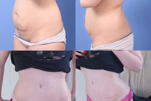 Abdominoplastia + Liposucción