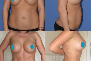Breast implant change + tummy tuck and liposuction