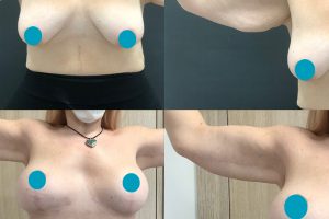 Arm lift + Breast lift