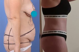 Circumferential tummy tuck + Breast lift and enlargement