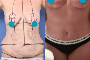 360 tummy tuck + breast lift with enlargement