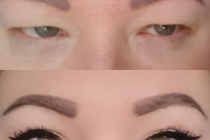 Asian eyelid surgery