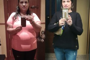Bariatric-surgery-before-and-after19