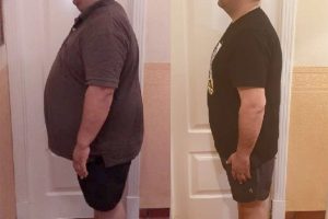 Bariatric-surgery-before-and-after7