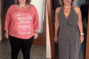 Bariatric-surgery-before-and-after8