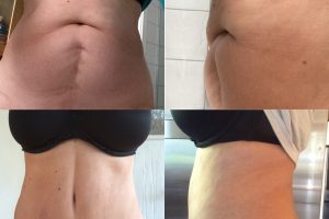 Waist liposuction + Tummy tuck