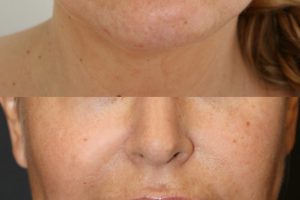 Chin liposuction + buccal fat pad removal
