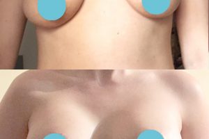 Увеличение груди + Подтяжка груди