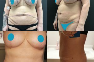 Tummy tuck + flanks liposuction +breast implants removal + breast lift