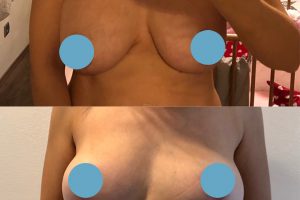 Подтяжка груди + Увеличение груди