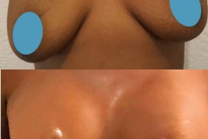 Подтяжка груди + Увеличение груди