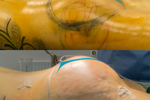 BBL + Stussförstoring med implantat