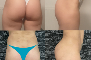 Buttock implants + Waist liposuction + Fat transfer to hip dips