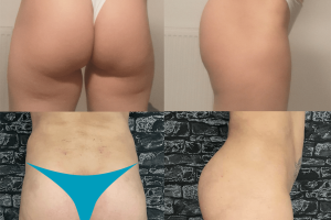Buttock implants + Waist liposuction + Fat transfer to hip dips