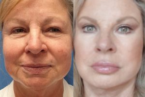 Facelift + upper and lower eyelid surgery
