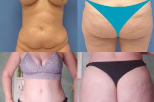 Tummy tuck + Waist liposuction + Fat transfer to buttocks
