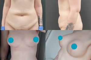 Tummy tuck + Breast lift with implants