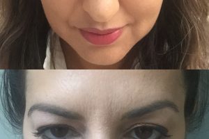Eyelid surgery + Chin liposuction + Fat transfer to face