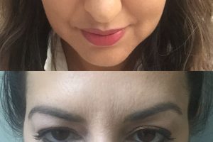 Øyelokkskirurgi + fettsuging av hake + fettransplantasjon til ansikt