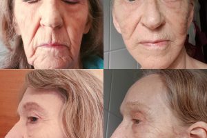 Estiramiento de cara + Transferencia de grasa a la cara + Levantamiento de cejas