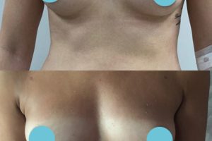Fat transfer to breasts