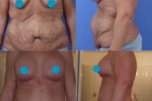 Fleur de Lis + Breast lift with implants