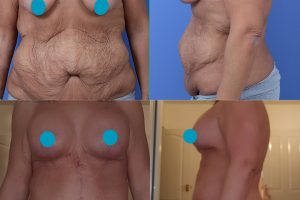 Абдоминопластика «Fleur de Lis» + Подтяжка груди и увеличение груди
