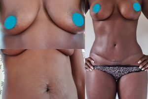 Tummy tuck + Liposuction + Breast lift with implants