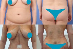 Abdominoplastia + Liposucción + Levantamiento de glúteos brasileño