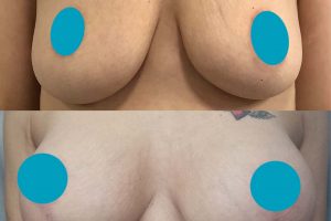 Breast lift + implants