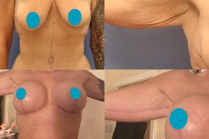 Arm lift + Breast lift with implants