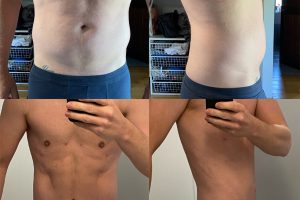 Mini tummy tuck, waist, abdomen and chest liposuction