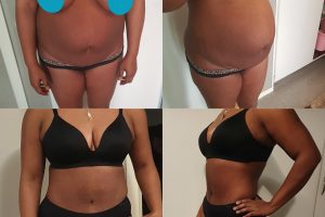 Tummy tuck + Breast reduction + Waist liposuction