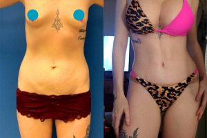 Tummy tuck + liposuction + breast enlargement