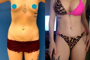 Tummy tuck + waist liposuction + breast enlargement with implants