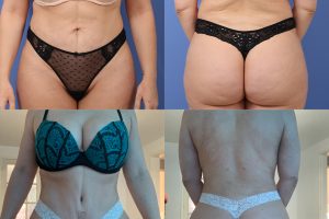 Brazilian butt lift + tummy tuck + arm liposuction