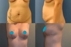 Tummy tuck + breast lift with implants