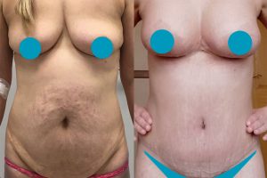 Tummy tuck + breast lift + implants